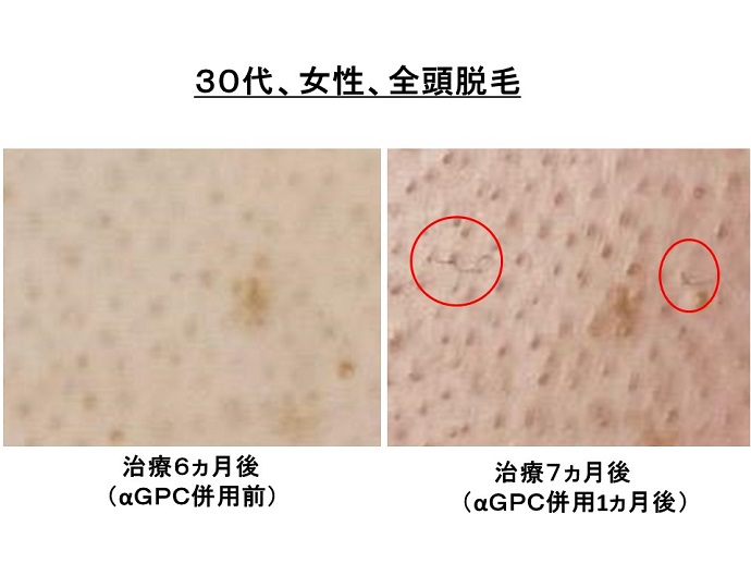 円形脱毛症　病院